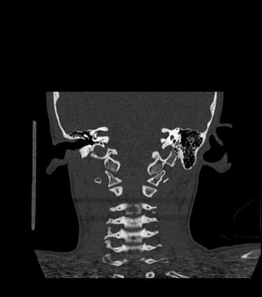 File:Nasoorbitoethmoid fracture (Radiopaedia 90044-107205 Coronal bone window 107).jpg