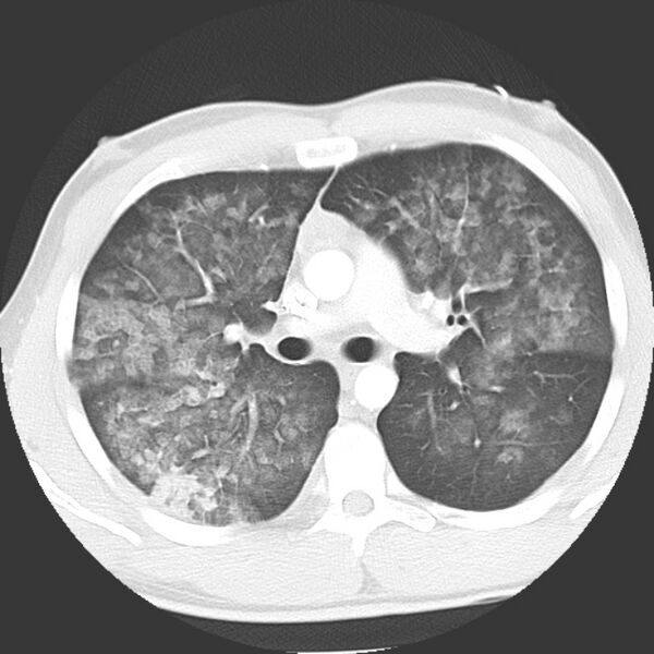 File:Near drowning pulmonary edema (Radiopaedia 16868-16591 Axial lung window 18).jpg