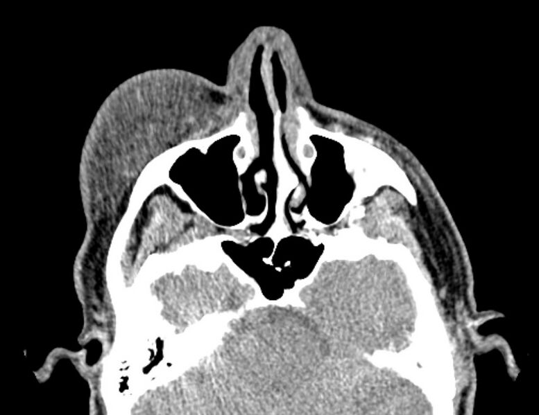File:Necrobiotic xanthogranuloma- face (Radiopaedia 29549-30052 Axial C+ delayed 7).jpg