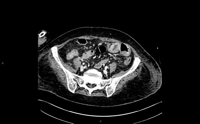 Neo-terminal ileal stricture (Crohn disease) (Radiopaedia 33790-34948 A 341).jpg