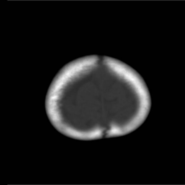 File:Neuroblastoma with skull metastases (Radiopaedia 30326-30958 Axial bone window 22).jpg