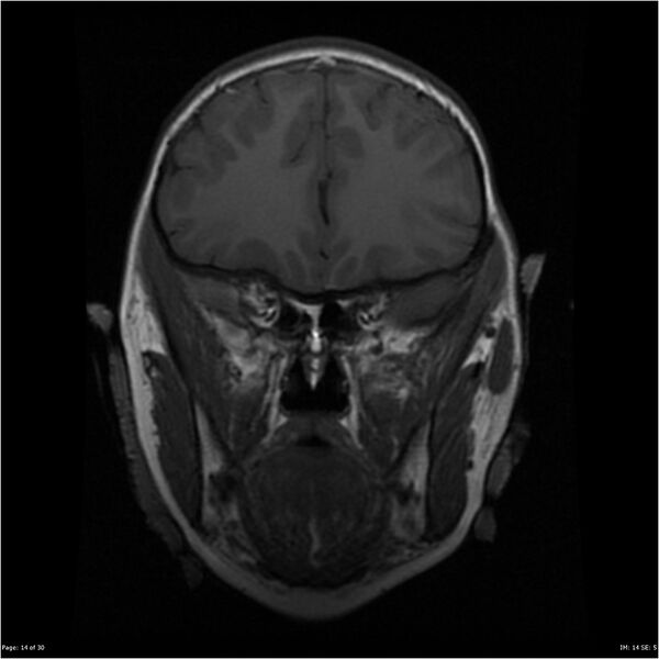 File:Neurofibromatosis type 1 (Radiopaedia 22541-22564 Coronal T1 23).jpg