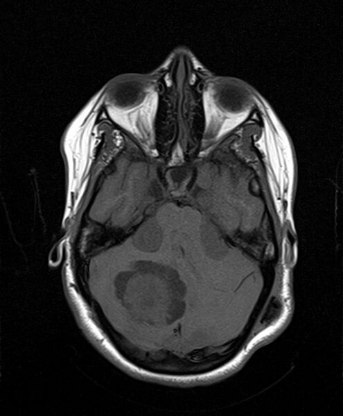 File:Neurofibromatosis type 2 (Radiopaedia 66211-75401 Axial T1 11).jpg