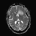 Neurotoxoplasmosis - concentric target sign (Radiopaedia 70644-80784 Axial ADC 12).jpg