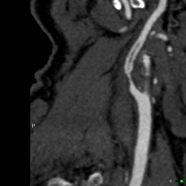 File:Non-occlusive intraluminal internal carotid artery thrombus (Radiopaedia 37751-39658 A 17).jpg