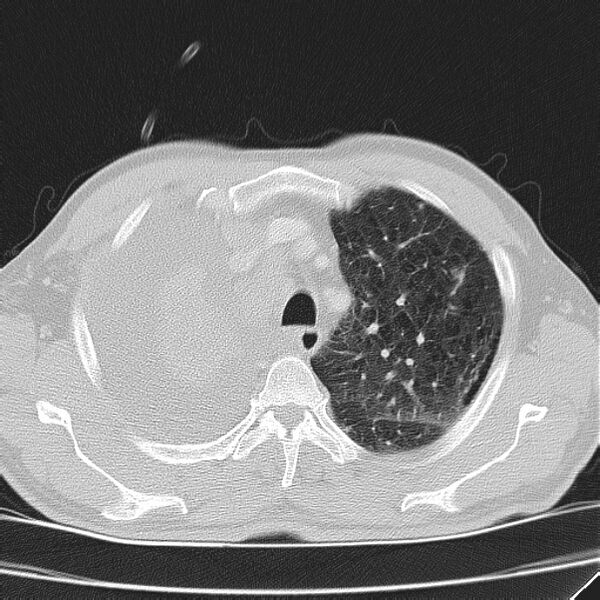 File:Non small-cell lung cancer (Radiopaedia 24467-24769 lung window 11).jpg