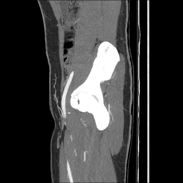 File:Normal CT angiogram of pelvis (Radiopaedia 45390-49430 C 23).jpg