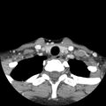 Normal CT of the neck (Radiopaedia 14575-14500 Axial C+ 58).jpg