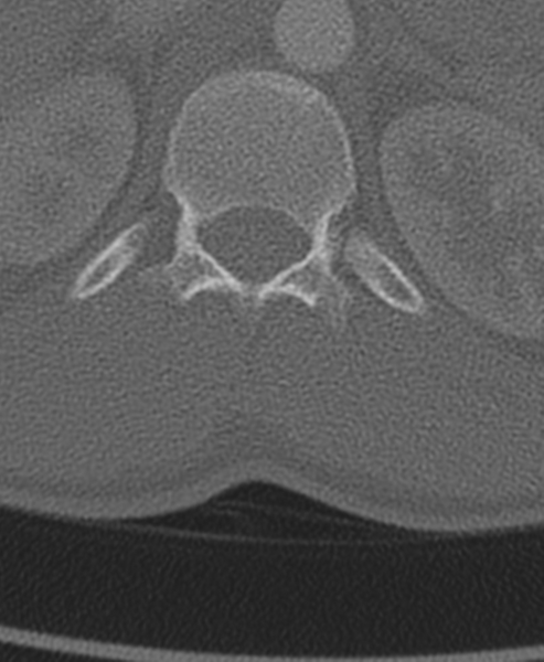 File:Normal CT thoracic spine (Radiopaedia 40181-42688 Axial bone window 100).png