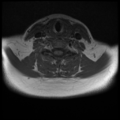 Normal cervical and thoracic spine MRI (Radiopaedia 35630-37156 Axial T1 14).png