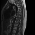 Normal cervical and thoracic spine MRI (Radiopaedia 35630-37156 I 4).png