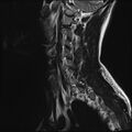 Normal cervical spine MRI (Radiopaedia 38418-40496 Sagittal T2 2).jpg