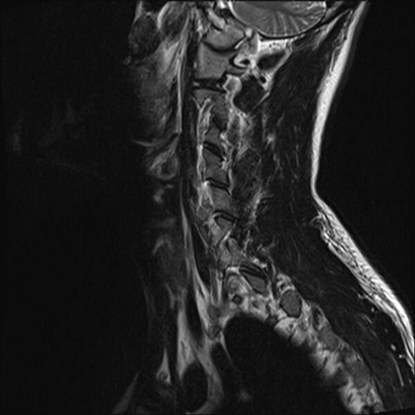 File:Normal cervical spine MRI (Radiopaedia 38418-40496 Sagittal T2 2).jpg