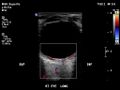 Normal eye ultrasound (Radiopaedia 70415-80514 A 9).jpg