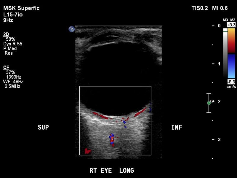 File:Normal eye ultrasound (Radiopaedia 70415-80514 A 9).jpg