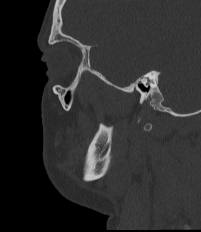 Normal facial bone CT (Radiopaedia 88742-105476 Sagittal bone window 125).jpg