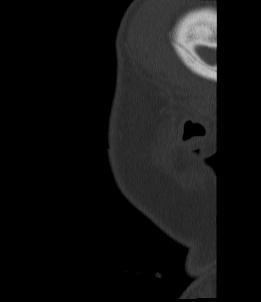Normal facial bone CT (Radiopaedia 88742-105476 Sagittal bone window 158).jpg