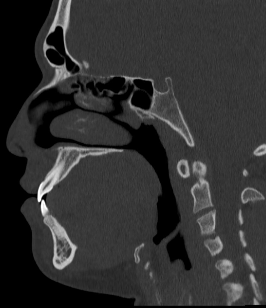 Normal facial bone CT (Radiopaedia 88742-105476 Sagittal bone window 83).jpg