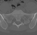Normal lumbar spine CT (Radiopaedia 46533-50986 Axial bone window 70).png