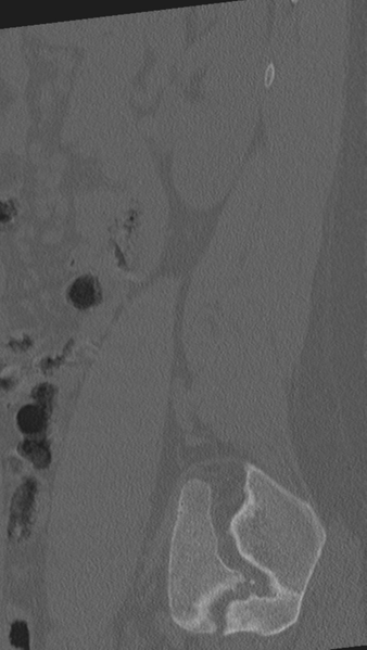 File:Normal lumbar spine CT (Radiopaedia 46533-50986 Sagittal bone window 15).png