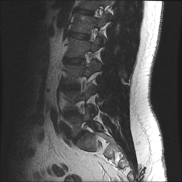 File:Normal lumbar spine MRI (Radiopaedia 43051-46311 Sagittal T2 6).jpg