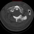 Occipital condyle fracture (Radiopaedia 18366-18208 Axial bone window 16).jpg