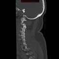 Occipital condyle fracture (Radiopaedia 18366-18208 Sagittal bone window 7).jpg