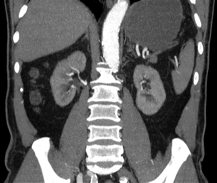 File:Abdominal aortic aneurysm (Radiopaedia 22421-22458 C 28).jpg