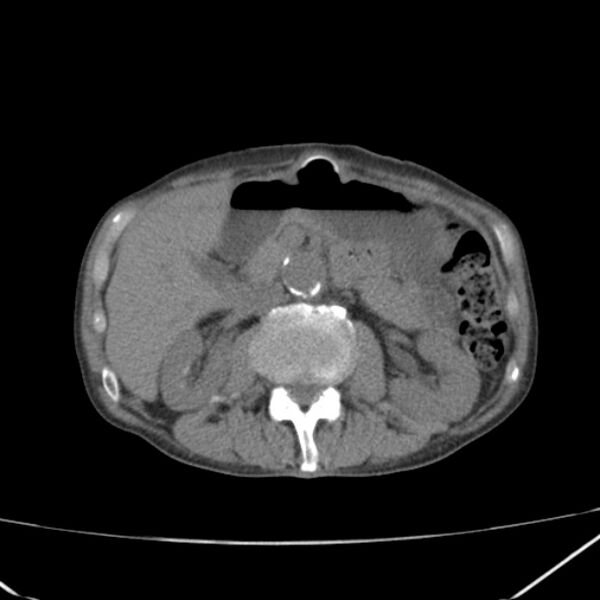 File:Abdominal aortic aneurysm (Radiopaedia 23703-23856 Axial non-contrast 21).jpg