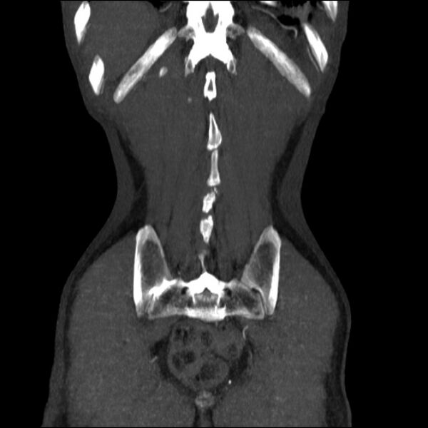 File:Abdominal aortic aneurysm (Radiopaedia 23703-23856 Coronal C+ arterial phase 33).jpg