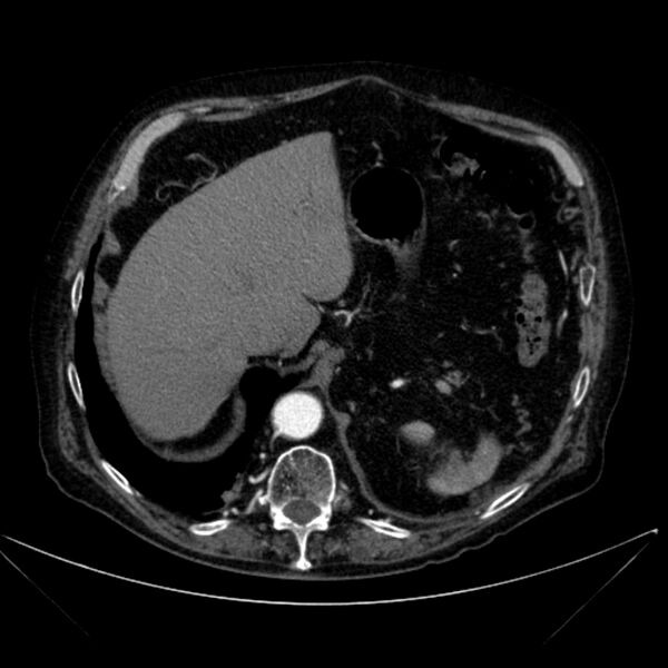 File:Abdominal aortic aneurysm (Radiopaedia 25855-26001 Axial C+ arterial phase 31).jpg