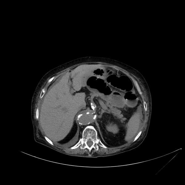 File:Abdominal aortic aneurysm - impending rupture (Radiopaedia 19233-19246 Axial non-contrast 35).jpg