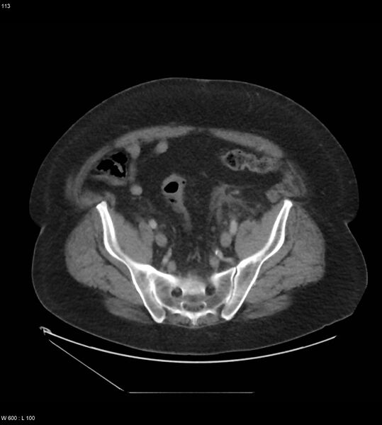 File:Abdominal aortic aneurysm with intramural hematoma then rupture (Radiopaedia 50278-55631 Axial C+ arterial phase 104).jpg