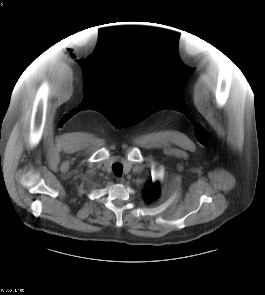 Abdominal aortic aneurysm with intramural hematoma then rupture (Radiopaedia 50278-55631 Axial non-contrast 1).jpg