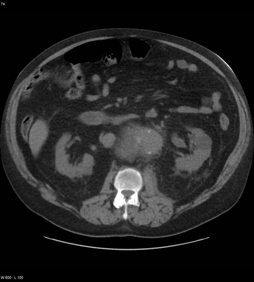 Abdominal aortic aneurysm with intramural hematoma then rupture (Radiopaedia 50278-55631 Axial non-contrast 70).jpg