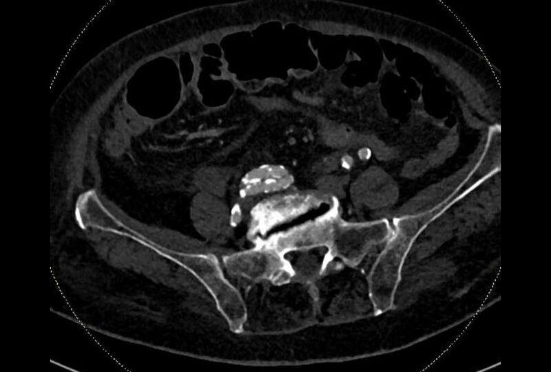 File:Abdominal aortic aneurysm with thrombus fissuration (Radiopaedia 73192-83919 Axial C+ arterial phase 156).jpg