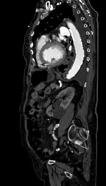 File:Abdominal aortic aneurysm with thrombus fissuration (Radiopaedia 73192-83919 Sagittal C+ arterial phase 45).jpg