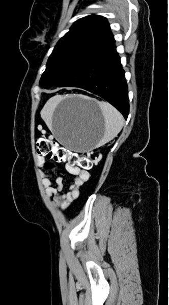 File:Abdominal hydatid disease (Radiopaedia 68223-77737 Sagittal C+ portal venous phase 11).jpg