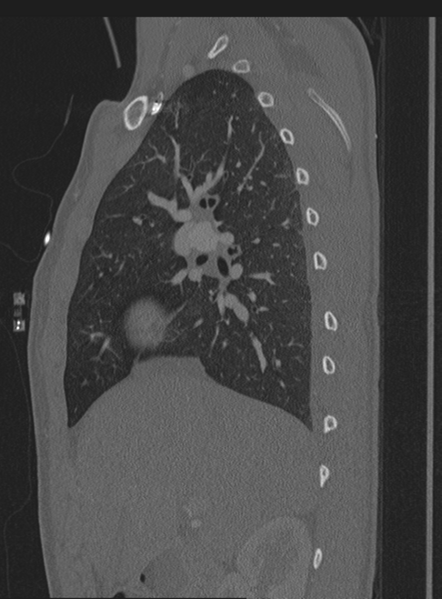 File:Abdominal multi-trauma - devascularised kidney and liver, spleen and pancreatic lacerations (Radiopaedia 34984-36486 Sagittal bone window 60).png