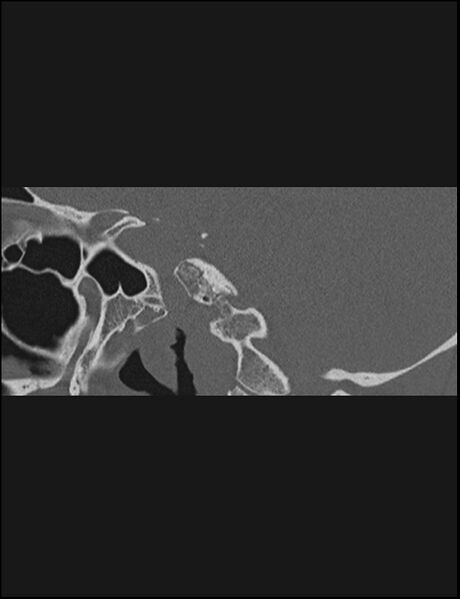 File:Aberrant right internal carotid artery (Radiopaedia 65191-74198 Sagittal non-contrast 84).jpg