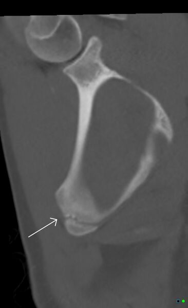 File:Accessory ossicle on the inferior angle of scapula (Radiopaedia 29222-29620 Coronal bone window 1).jpg