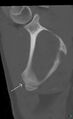 Accessory ossicle on the inferior angle of scapula (Radiopaedia 29222-29620 Coronal bone window 1).jpg