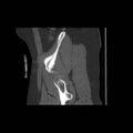 Acetabular fracture (Radiopaedia 13193-13212 Sagittal bone window 15).jpg