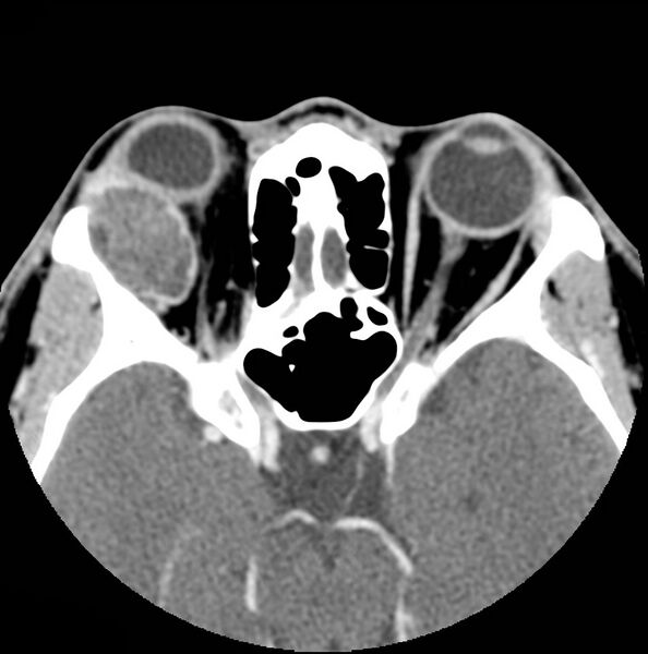 File:Acinic cell carcinoma of the lacrimal gland (Radiopaedia 9480-10160 Axial C+ arterial phase 7).jpg