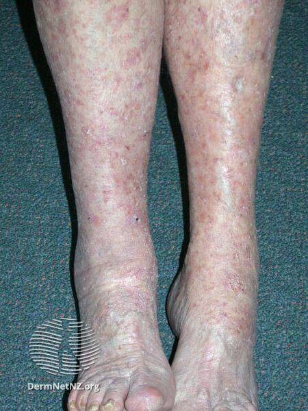 File:Actinic Keratoses affecting the legs and feet (DermNet NZ lesions-ak-legs-569).jpg