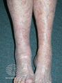 Actinic Keratoses affecting the legs and feet (DermNet NZ lesions-ak-legs-569).jpg
