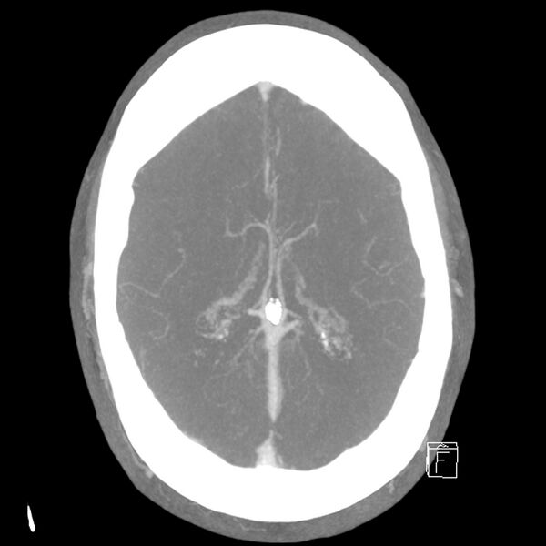 File:Acute A3 occlusion with ACA ischemic penumbra (CT perfusion) (Radiopaedia 72036-82527 Axial 10 sec delay thick MIP 7).jpg