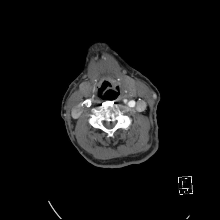 Acute ICA ischemic penumbra due to high-grade CCA stenosis (CT perfusion) (Radiopaedia 72038-82530 Axial C+ arterial phase 44).jpg