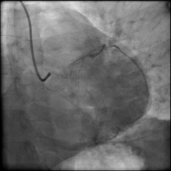 File:Acute anteroseptal myocardial infarction (Radiopaedia 68409-77946 LAO caudal (spider view) LAD and CX 71).jpg