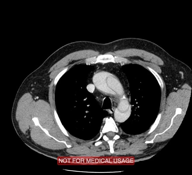 File:Acute aortic dissection - Stanford type A (Radiopaedia 40661-43285 Axial C+ portal venous phase 6).jpg